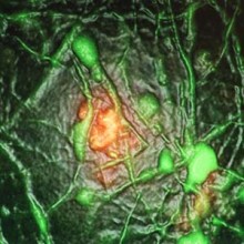 Microscopic view of brain cells (neurons) stained green, with one damaged cell orange/red.